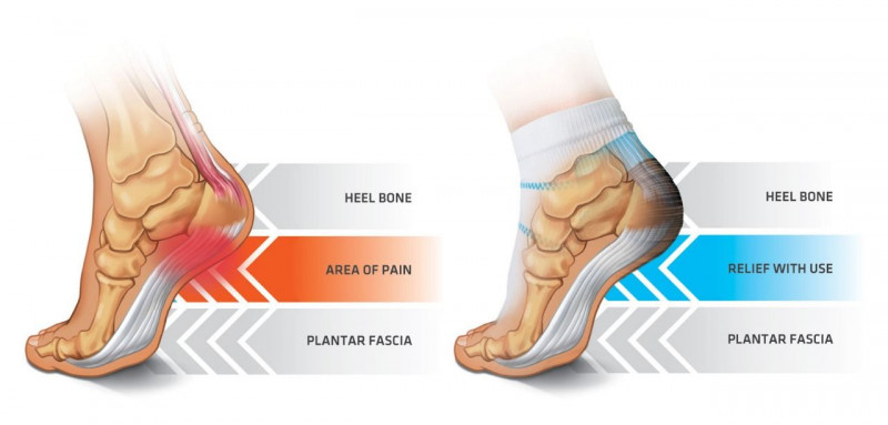 Plantar deals fasciitis terapi