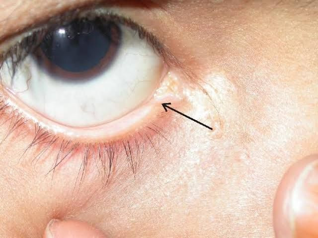 Fungsi Lacrimal Punctum Lubang Kecil Di Kelopak Mata Bawah Yesdok