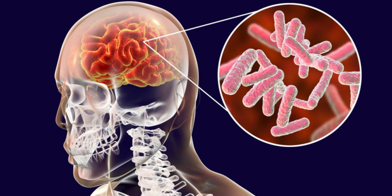 Penyakit Meningitis, Gejala, Penyebab Dan Cara Menanganinya - News+ On ...