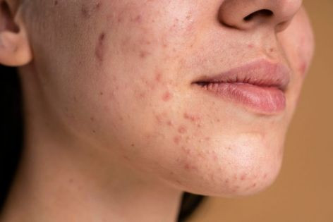 Ini Cara Membedakan Fungal Acne Dan Jerawat Biasa Yesdok